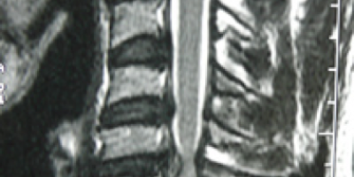 Spinal Cord Injury