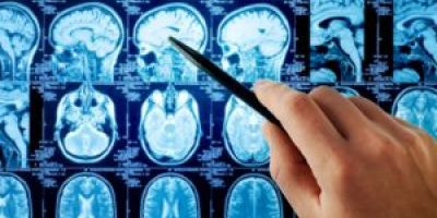 Important Things to Know About Brain Tumors
