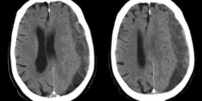 Subdural Hematoma