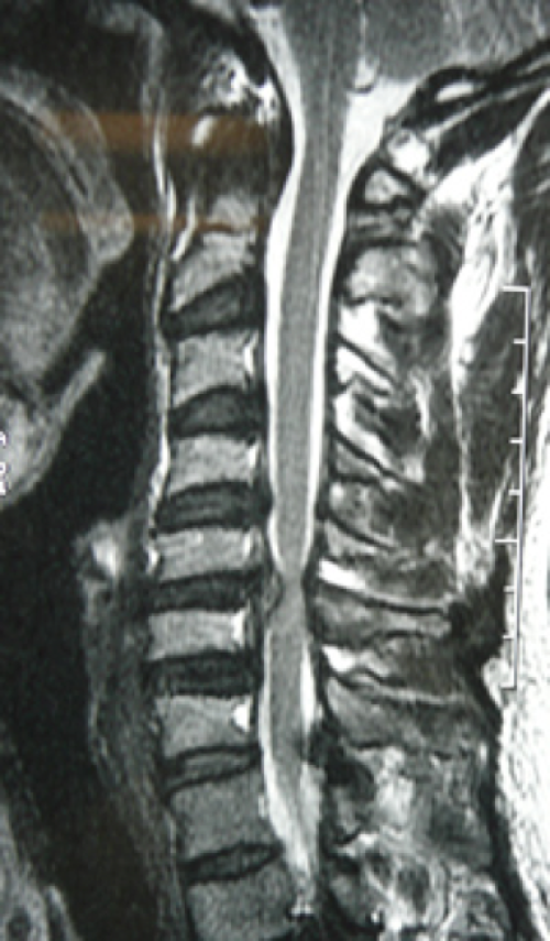 Cervical Spinal Cord Injury