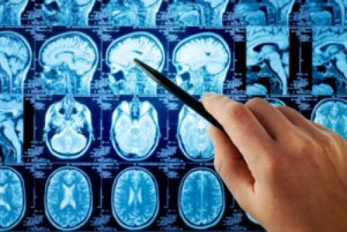 Important Things to Know About Brain Tumors