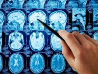 Important Things to Know About Brain Tumors