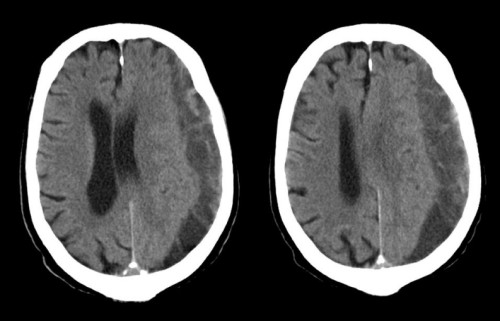 subdural hematoma mri